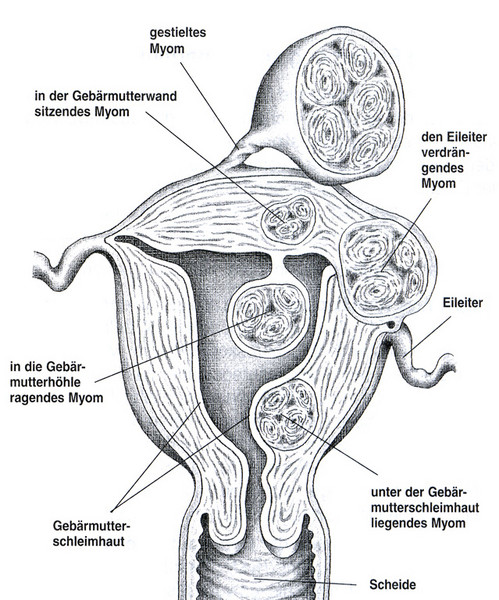 Verschiedene Arten von Myomen
