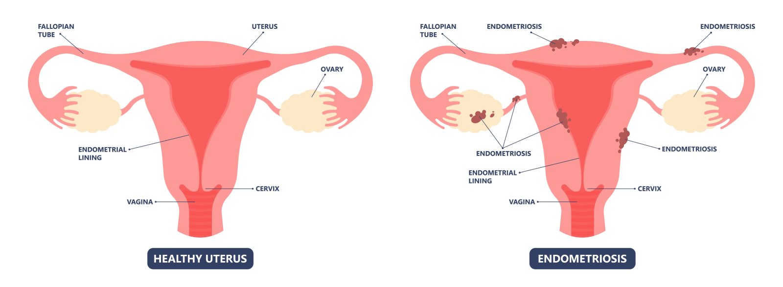 endometriose uterus